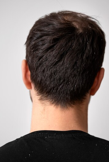 Dandruff