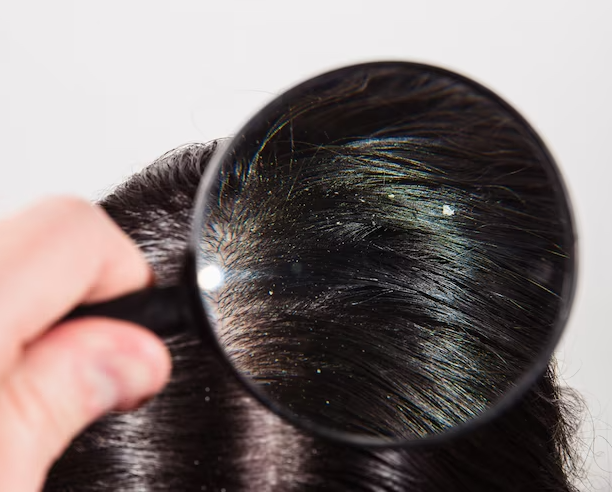 How do you get rid of Dandruff Permanently?